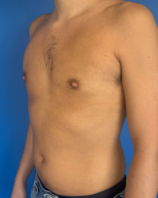 Gynecomastia case #4122