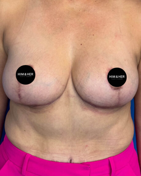 Implant Removal case #4621