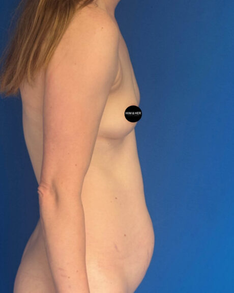 Mommy Makeover case #4624