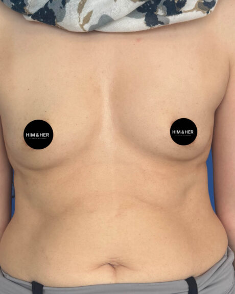 Breast Augmentation case #4627