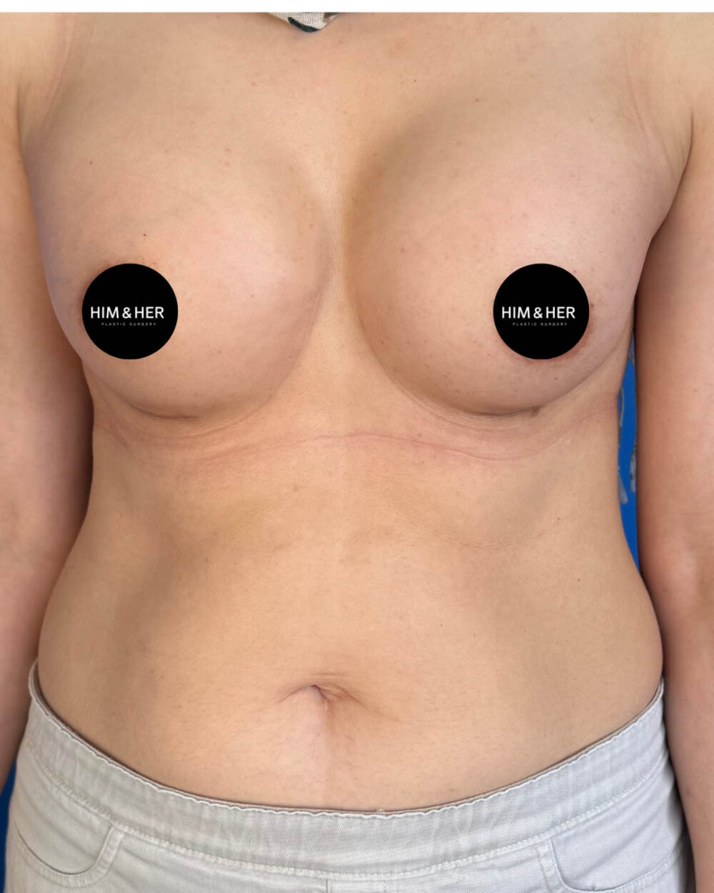 Breast Augmentation case #4627