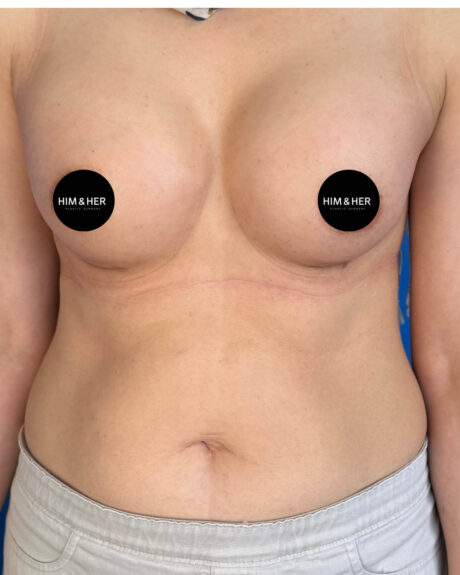 Breast Augmentation case #4627