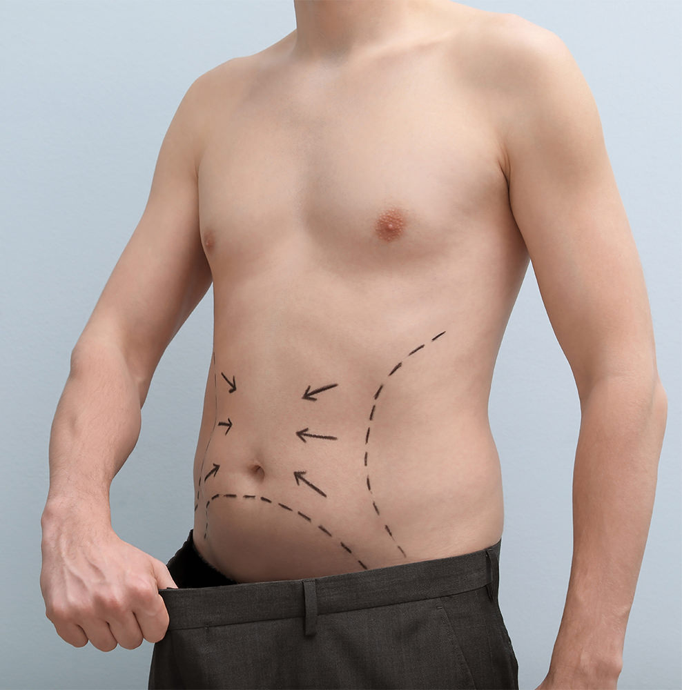 Male Liposuction in Plano: When Fat Refuses to Budge