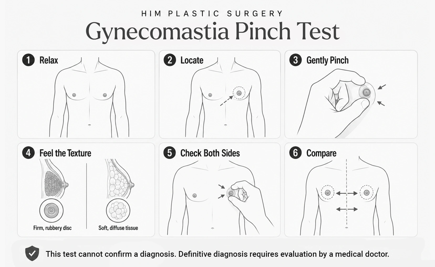 Gynecomastia pinch test in six steps, comparing firm glandular tissue with soft fat